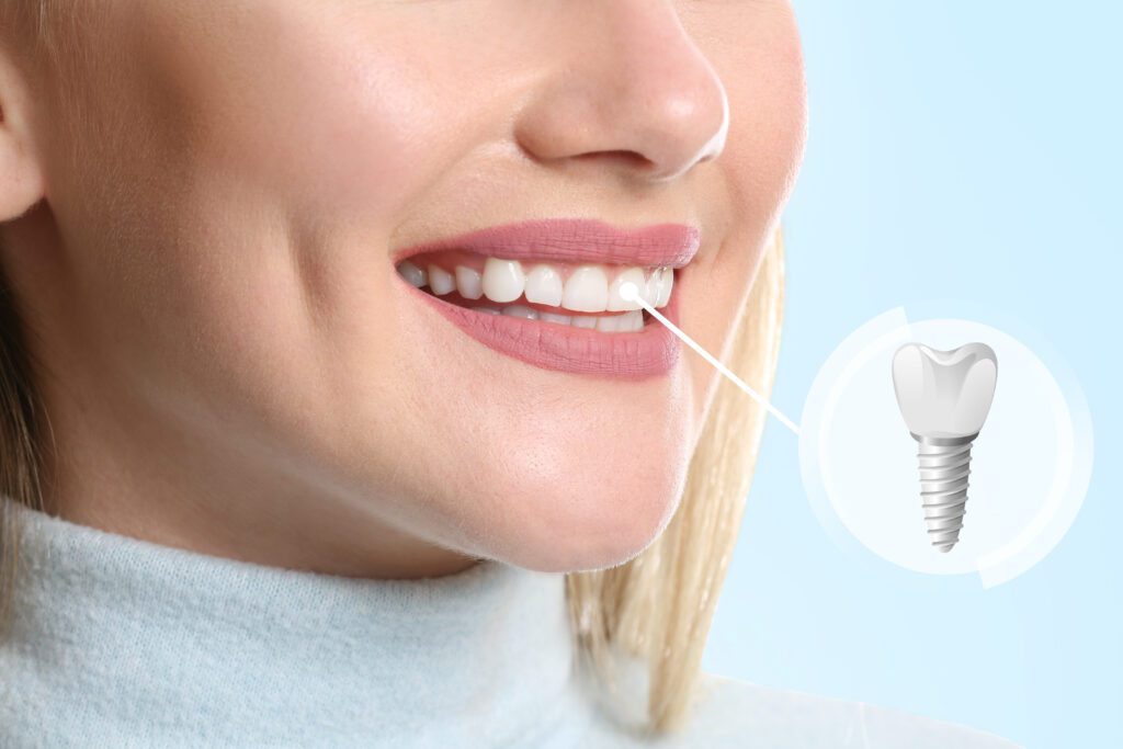 Implantes dentales: qué son y para que sirven