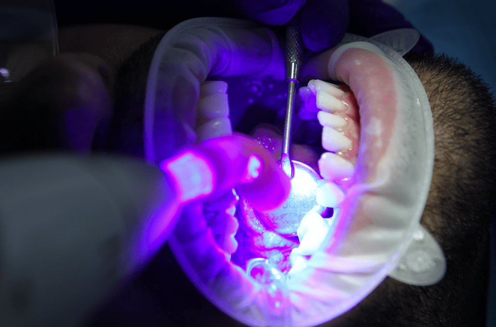 blanqueamiento dental en paciente
